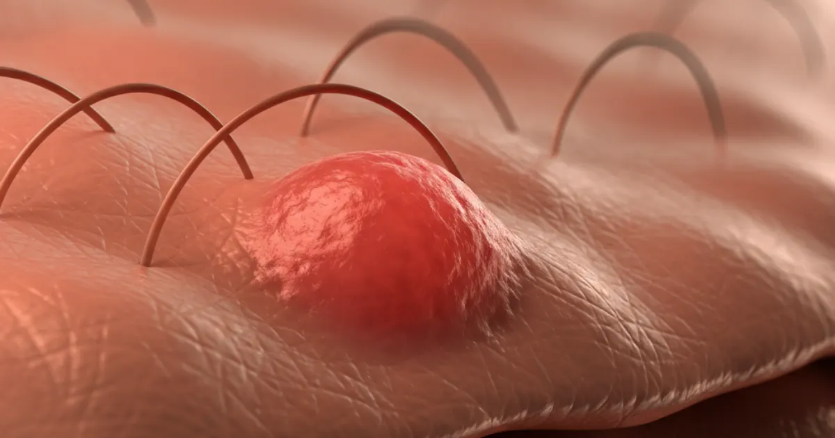 What Does an Ingrown Hair Look Like